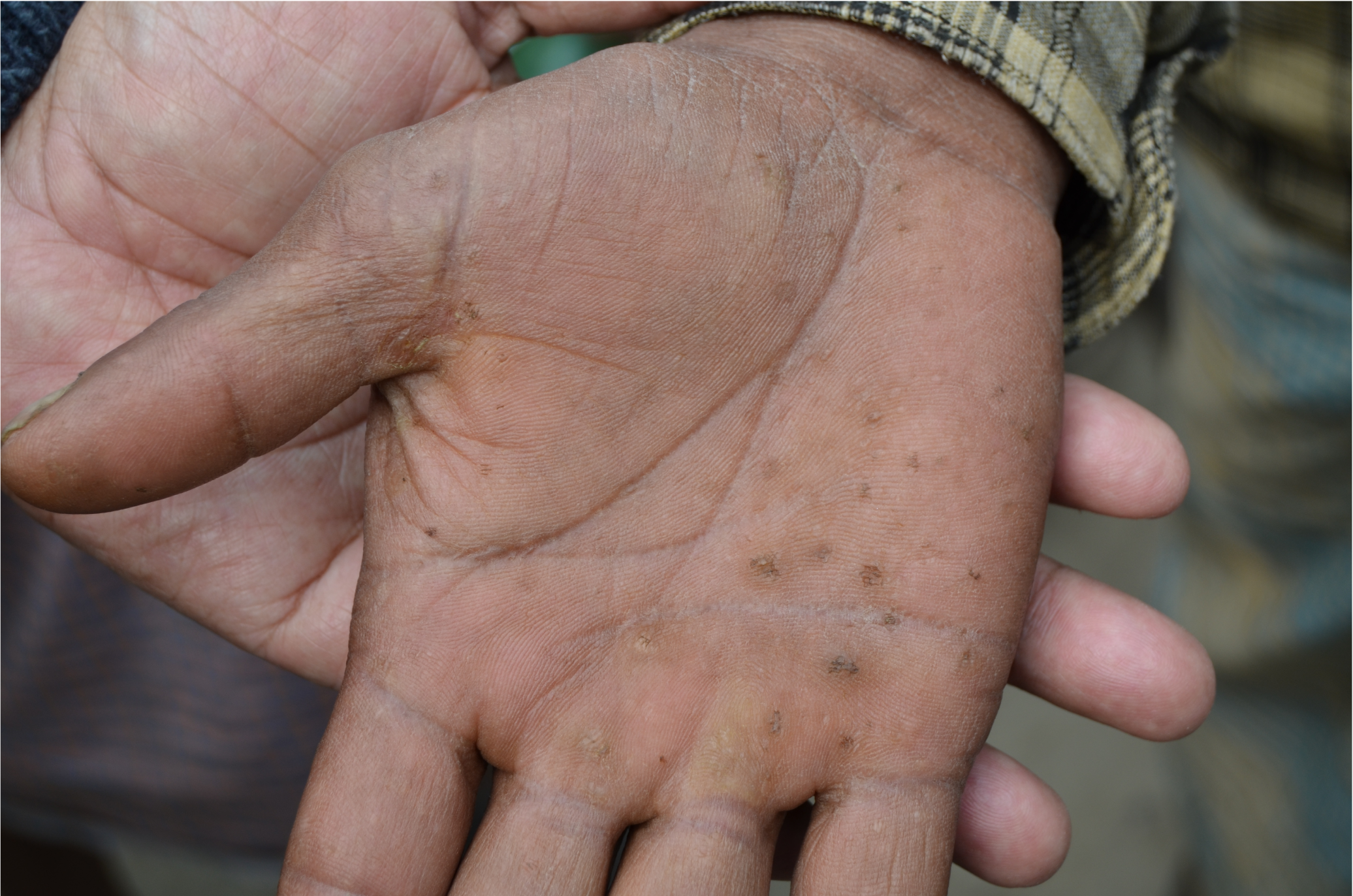 Skin lesions that are characteristic of damage from drinking water arsenic exposure.
                           Photograph by David Funkhouser, Earth Institute of Columbia University.